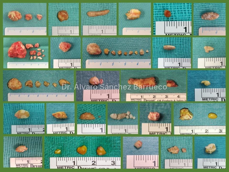 ¿Es posible tener piedras en las glándulas salivales?
