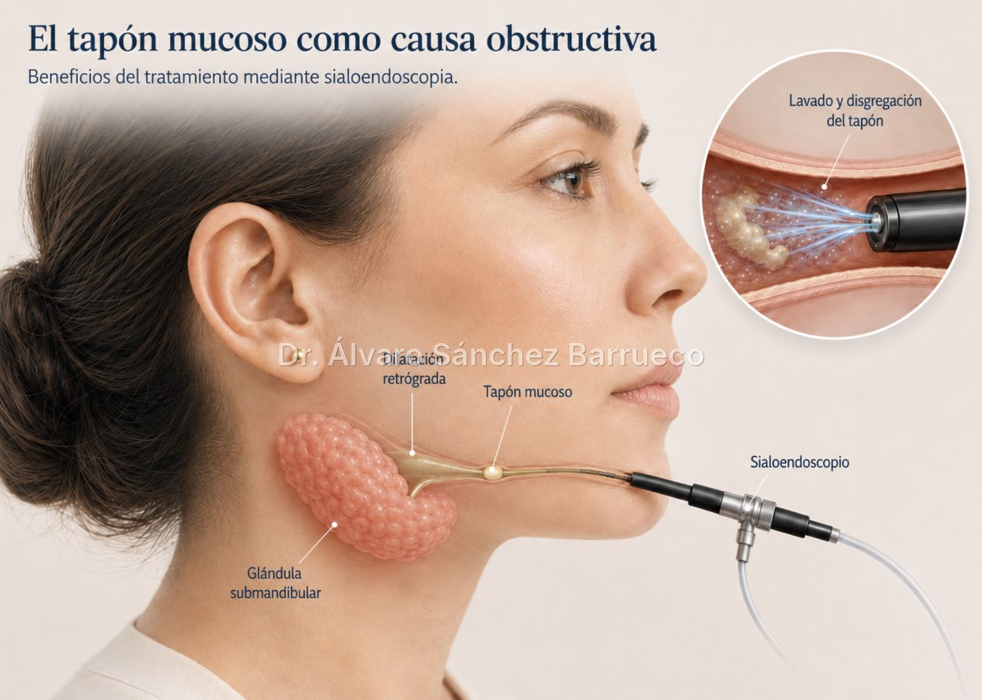 ¿Qué son los tapones mucosos en las glándulas salivales?