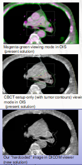 GitHub - jaibrat/hardcode_PTV_onto_CBCT: In radiotherapy, this Python ...