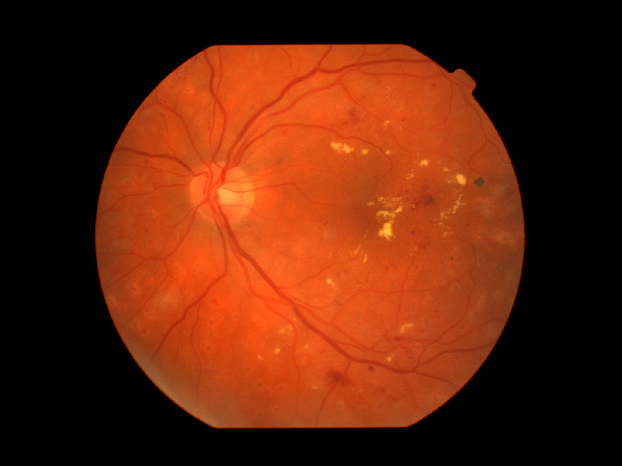 GitHub - Janmacek/retina-disease-classifier