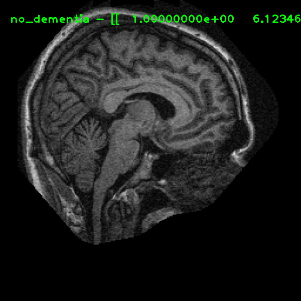 RAW MRI - Nondemented