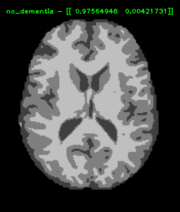 FSL_SEG MRI - Nondemented