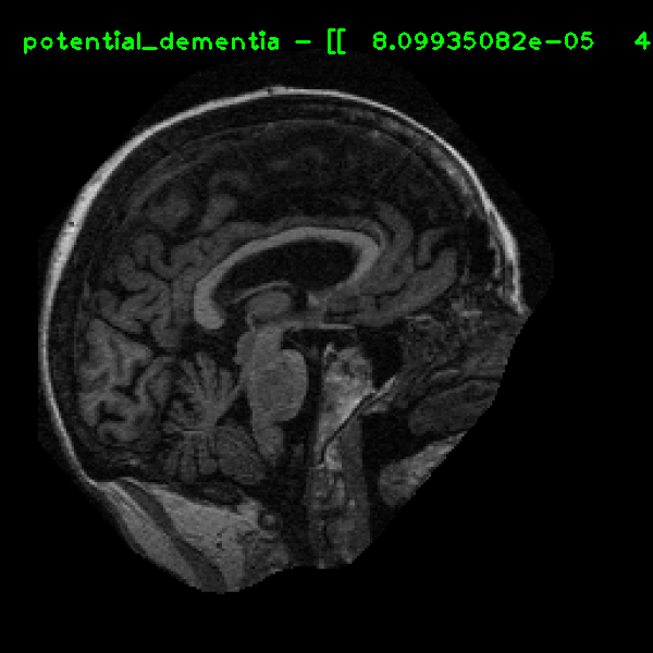 RAW MRI - Possibly demented