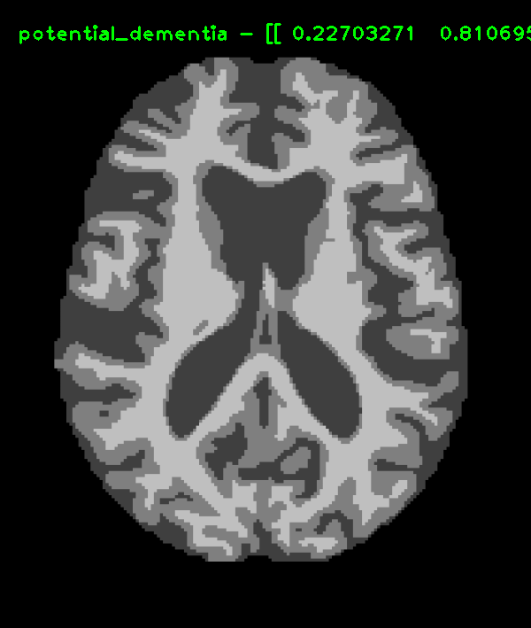 FSL_SEG MRI - Possibly demented