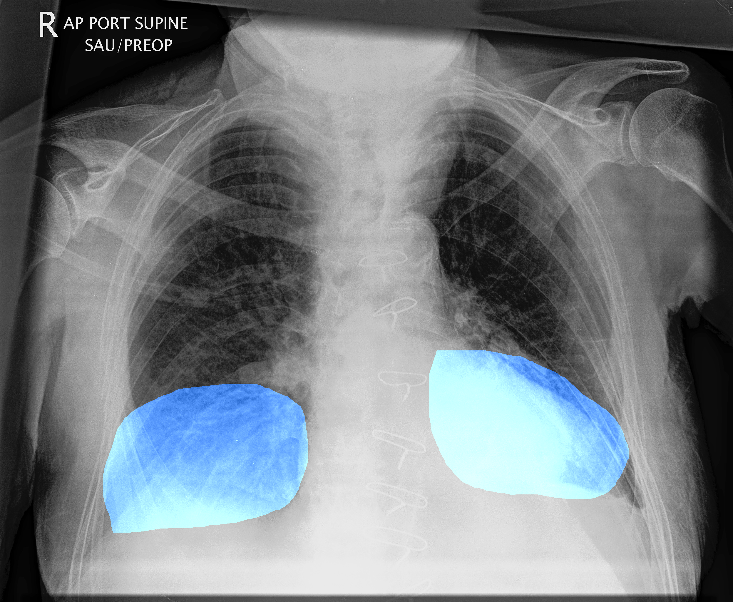 example CXR with two segmentations