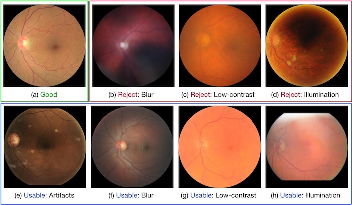 Examples of different retinal image quality grades.