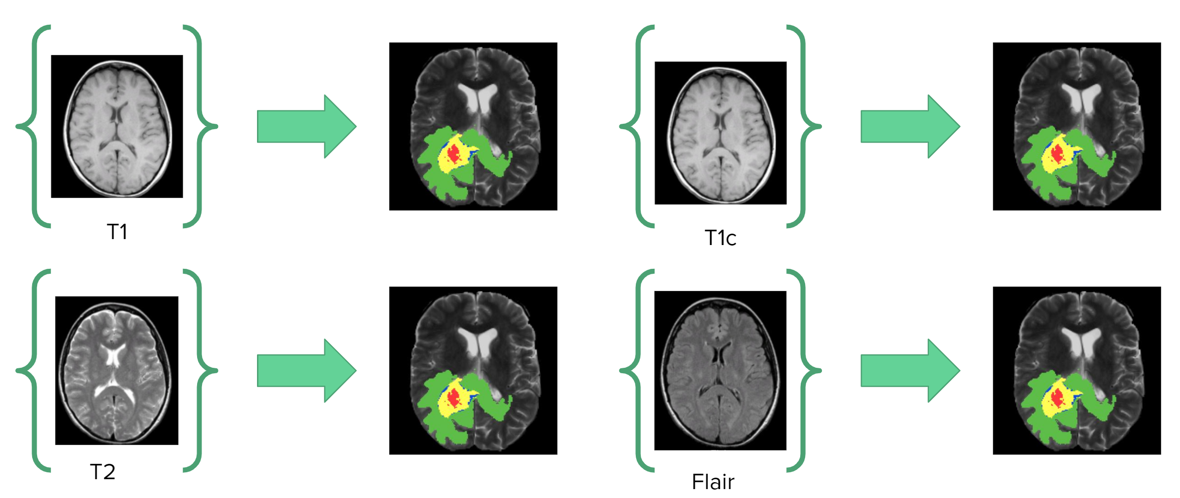 GitHub - Joekrinke15/Brain-Tumor-Segmentation-Using-Single-MRI ...