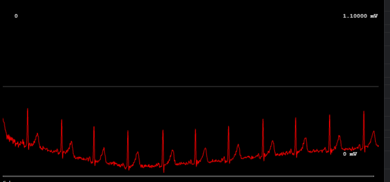 ECG