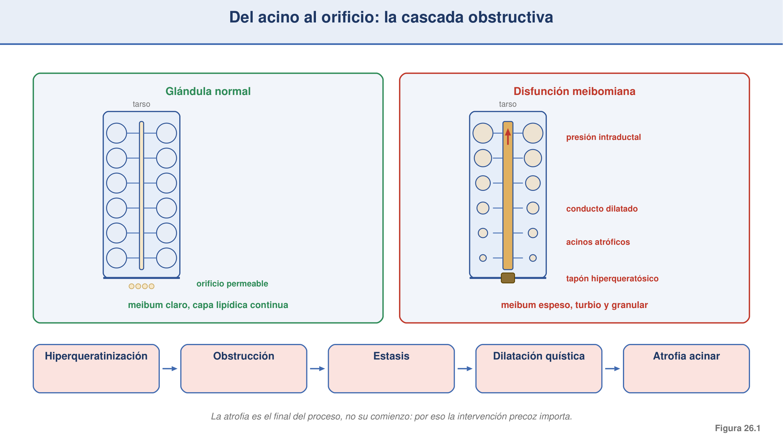 Figura 26.1 — Del acino al orificio: cascada obstructiva de la DGM