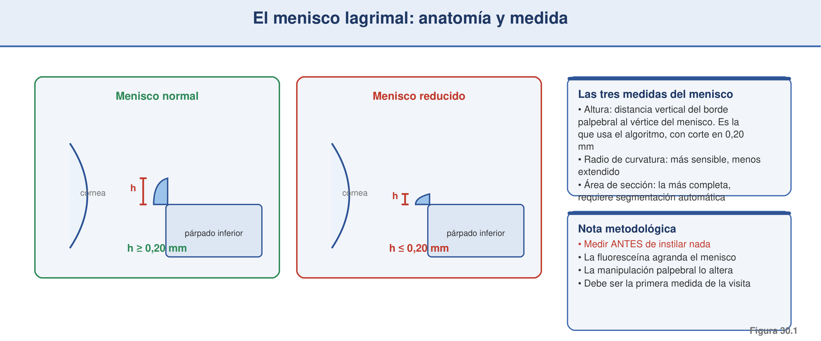 Figura 30.1 — El menisco lagrimal: anatomía y medida