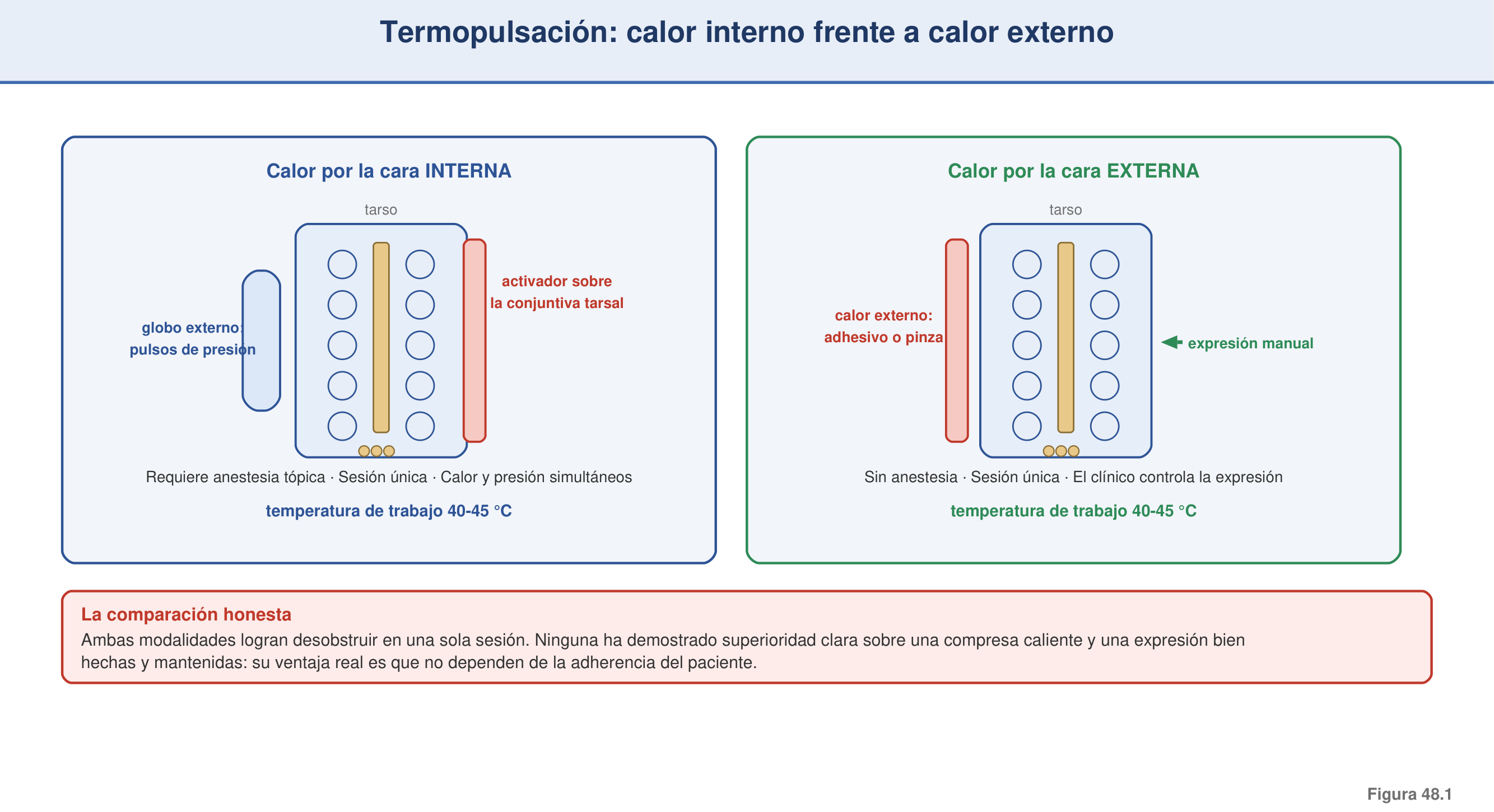 Figura 48.1 — Termopulsación: calor interno frente a calor externo