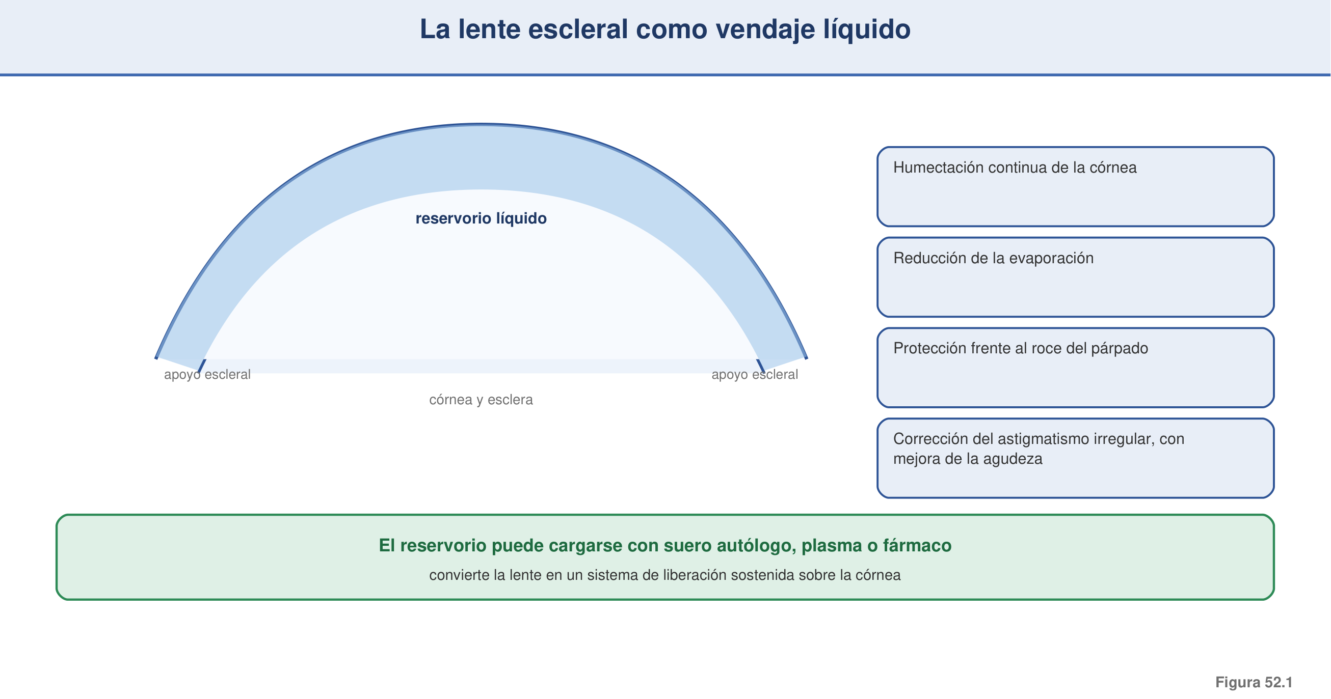 Figura 52.1 — La lente escleral como vendaje líquido