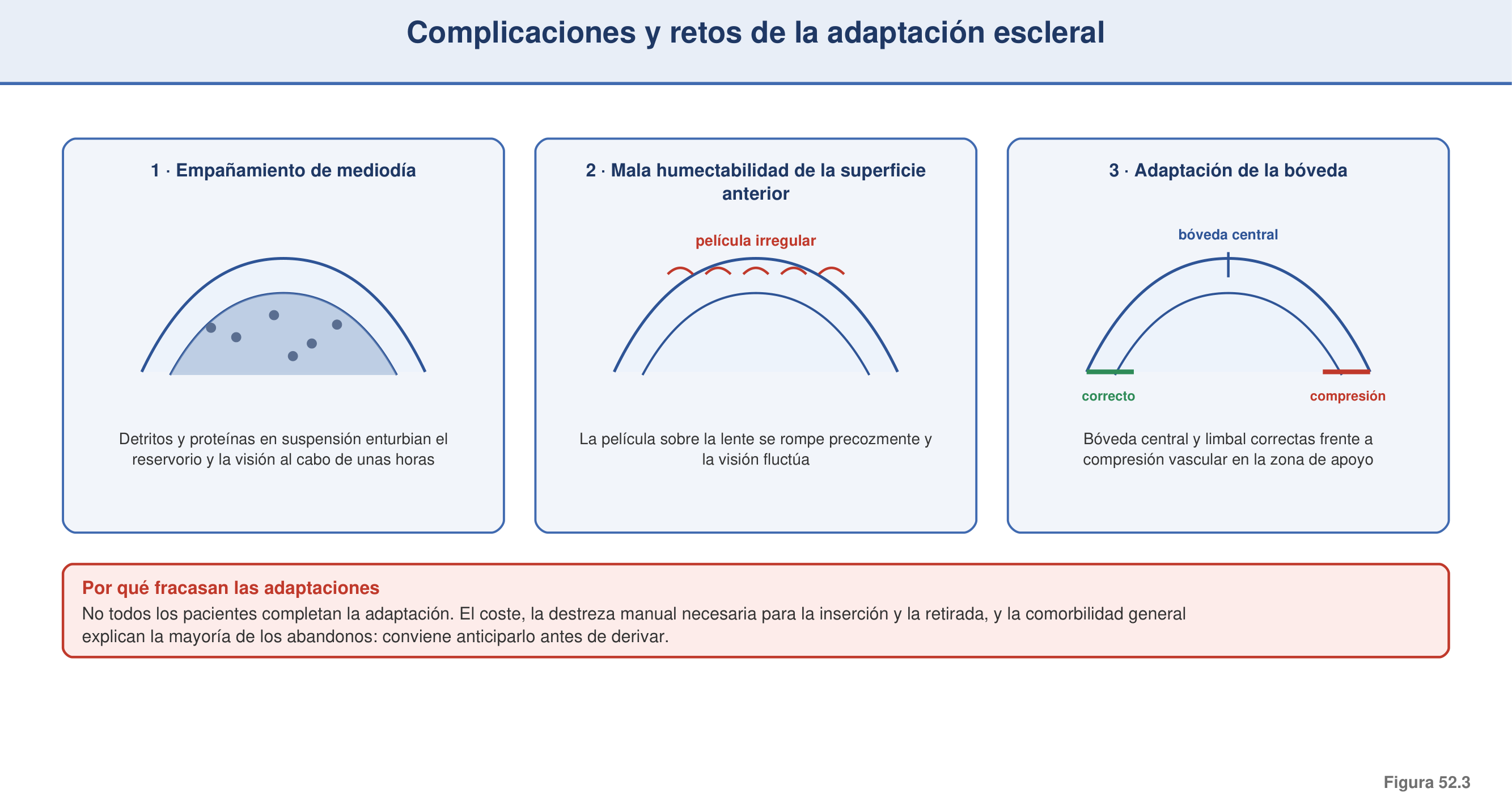 Figura 52.3 — Complicaciones y retos de la adaptación escleral