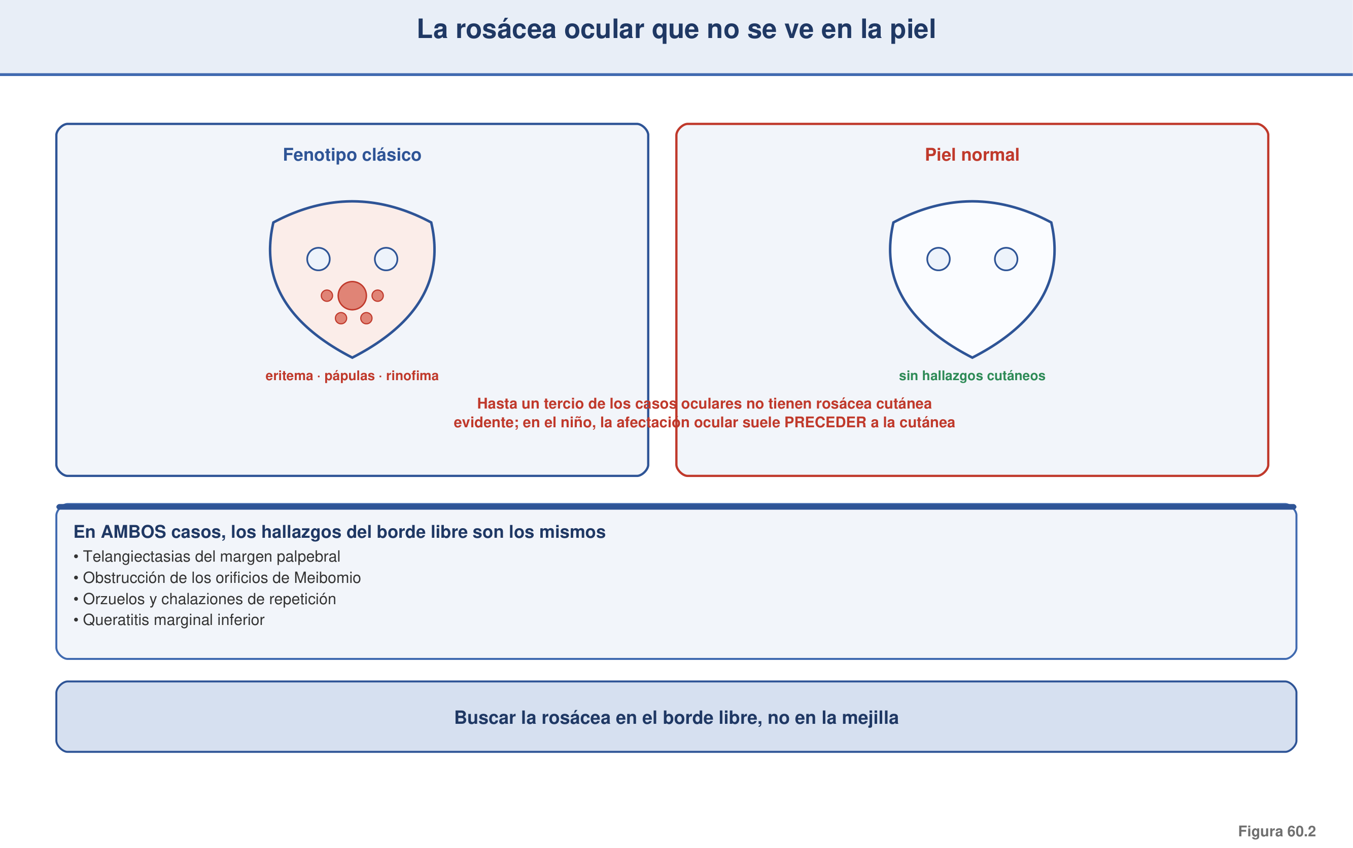 Figura 60.2 — La rosácea ocular que no se ve en la piel