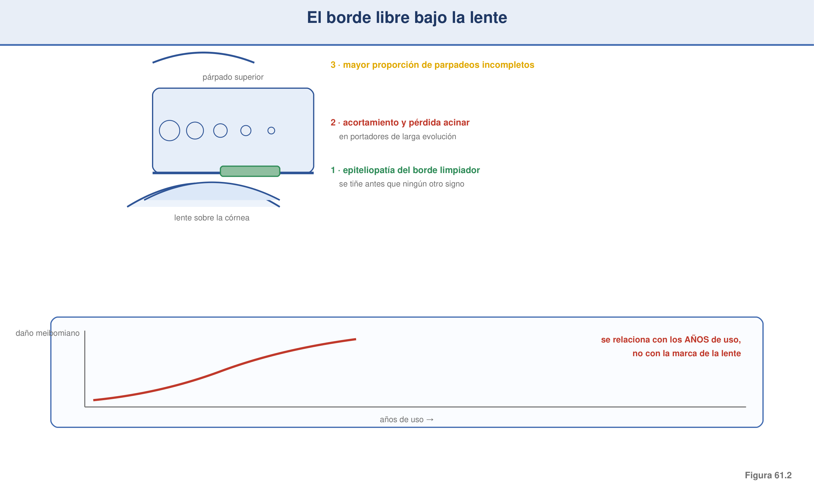 Figura 61.2 — El borde libre bajo la lente