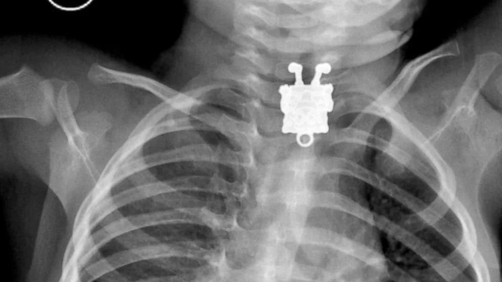 x-ray swallowed toy