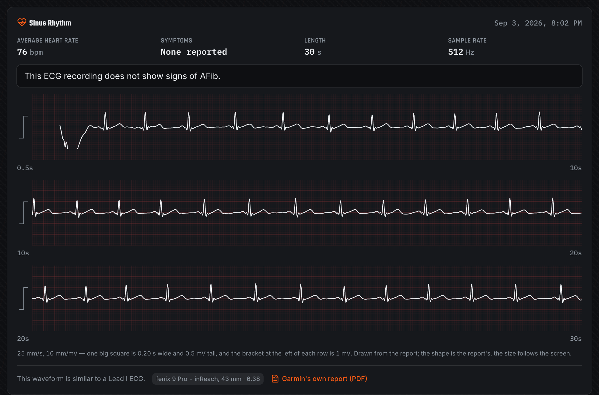 Three ECG strips imported from a Garmin ECG PDF, the maintainer's own recording