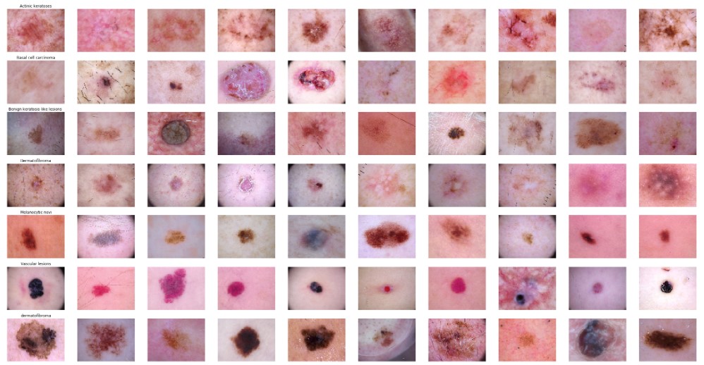 Skin Lesion Analysis Toward Melanoma Detection 2018 A Challenge Hosted By The International