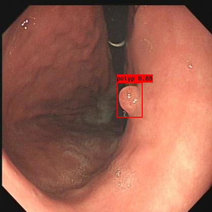 gastric polyp detection