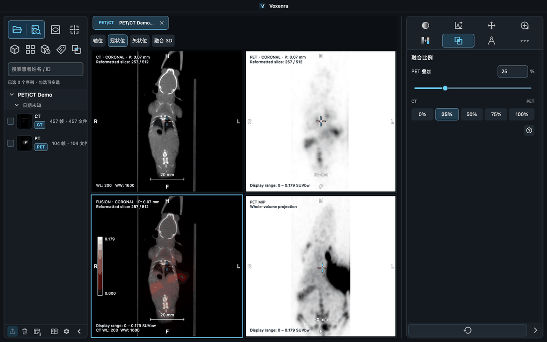 PET/CT 切面与融合比例切换