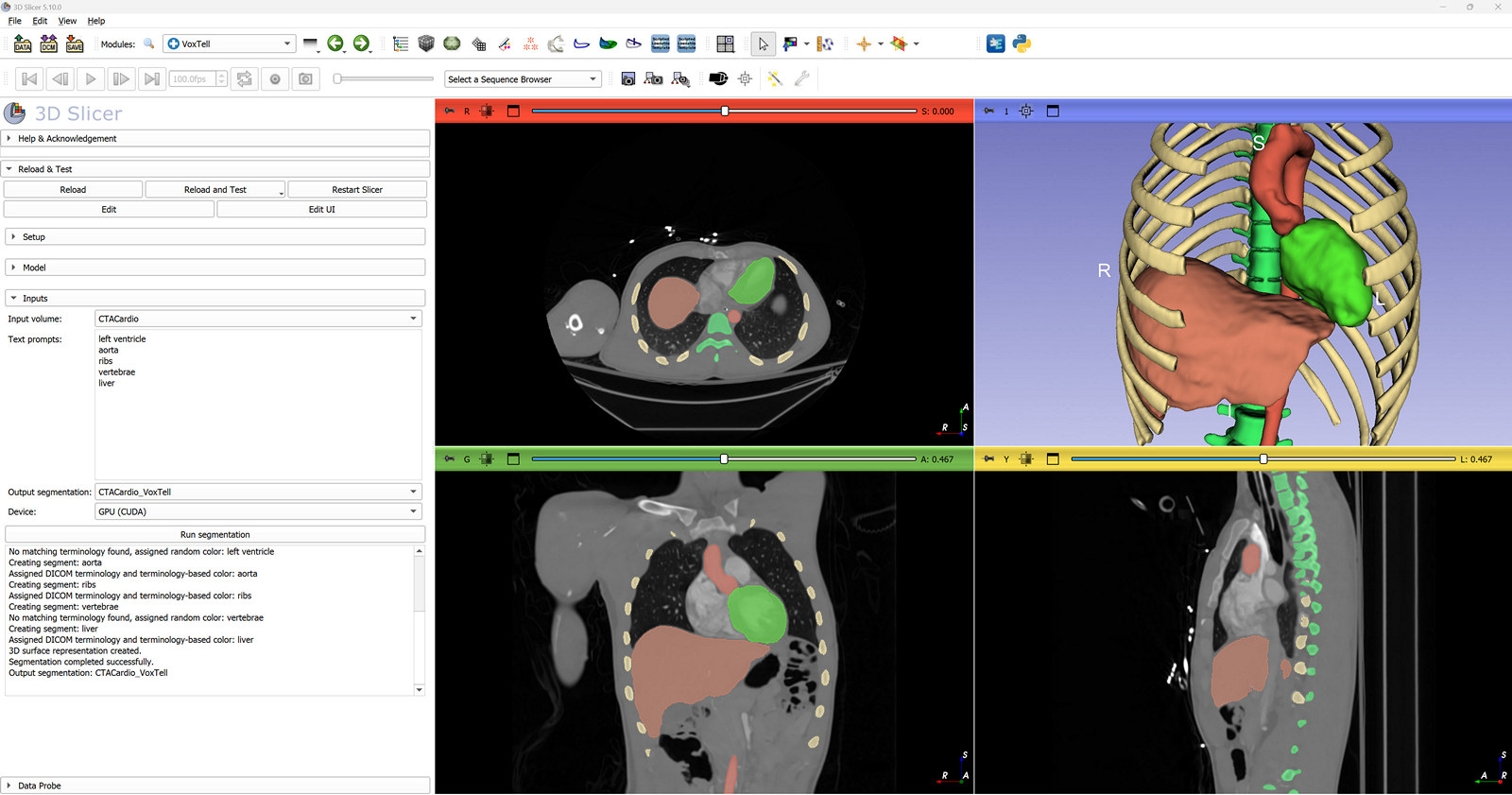 SlicerVoxTell screenshot