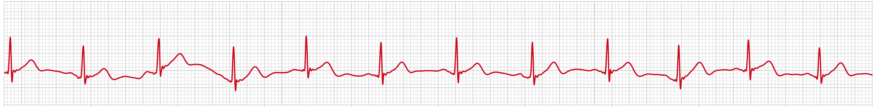 ECG