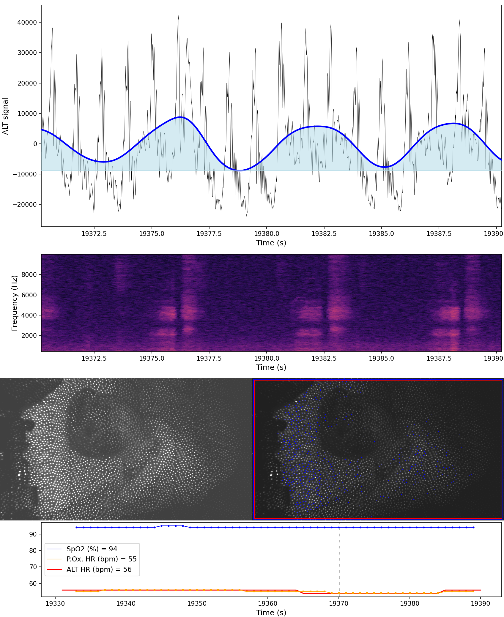 An example of using the ALT tech to monitor respiration during sleep