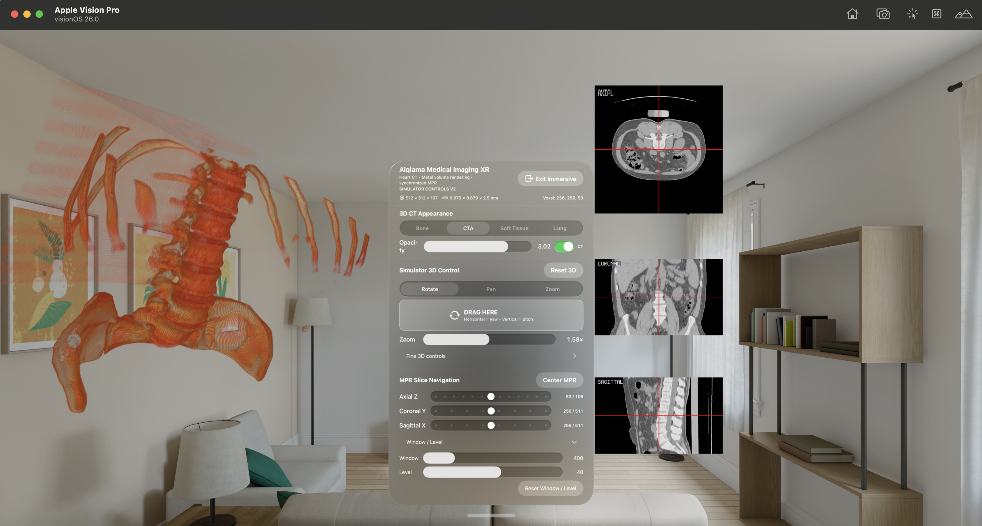 Apple Vision Pro Medical XR workspace with 3D CT volume and orthogonal slice views
