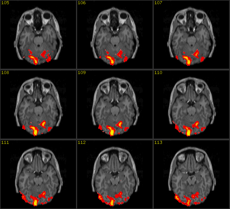 fMRI Scan Image