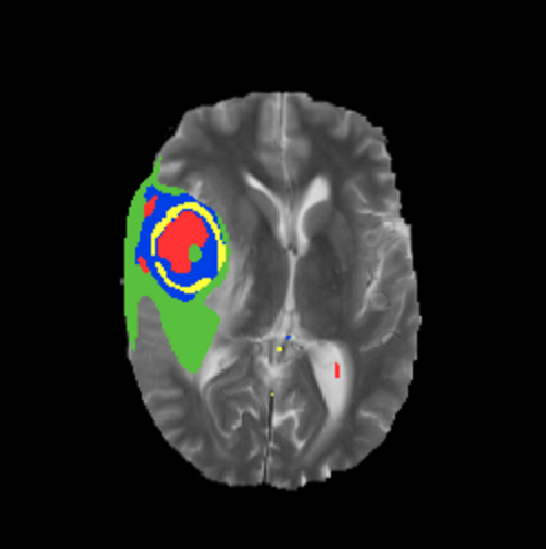 Improved segmentation results after restricting the amount of 