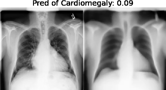 Cardiomegaly-XRV.gif