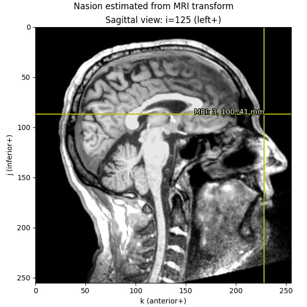 Nasion estimated from MRI transform, Sagittal view: i=125 (left+)