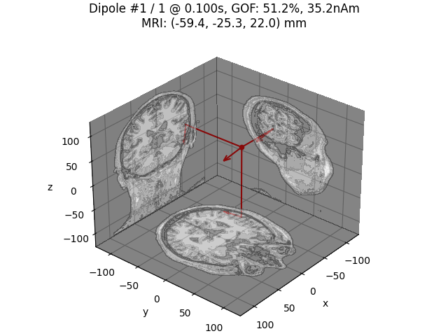 Dipole #1 / 1 @ 0.100s, GOF: 51.2%, 35.2nAm MRI: (-59.4, -25.3, 22.0) mm