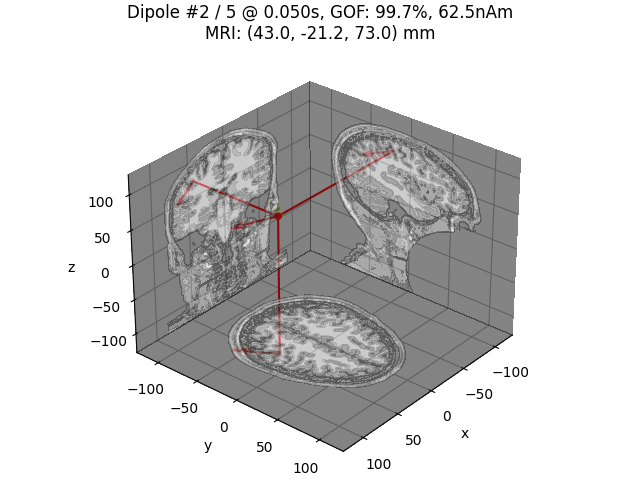 Dipole #2 / 5 @ 0.050s, GOF: 99.7%, 62.5nAm MRI: (43.0, -21.2, 73.0) mm