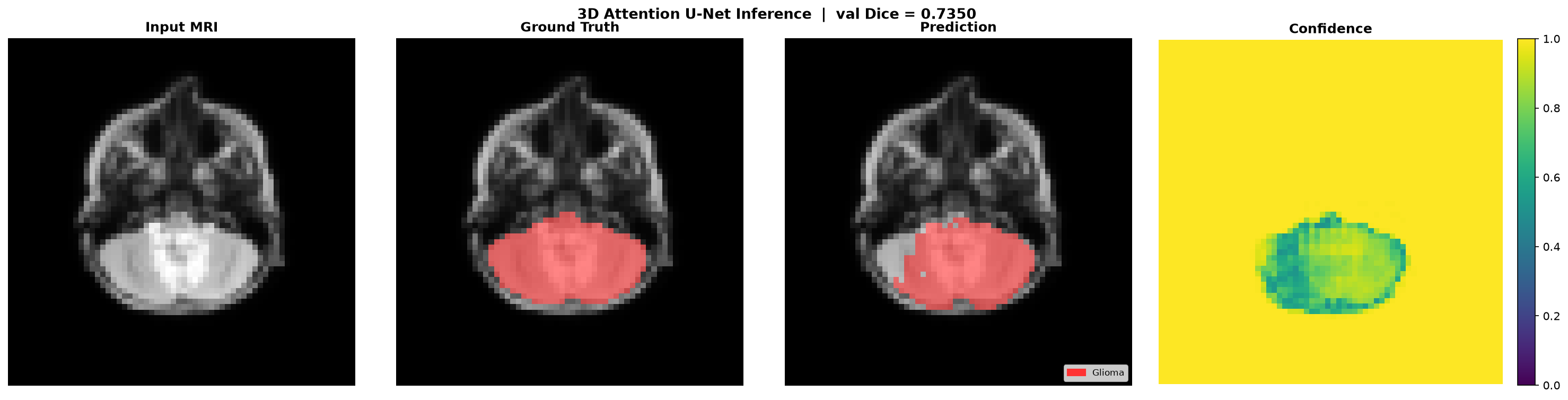 Glioma Inference