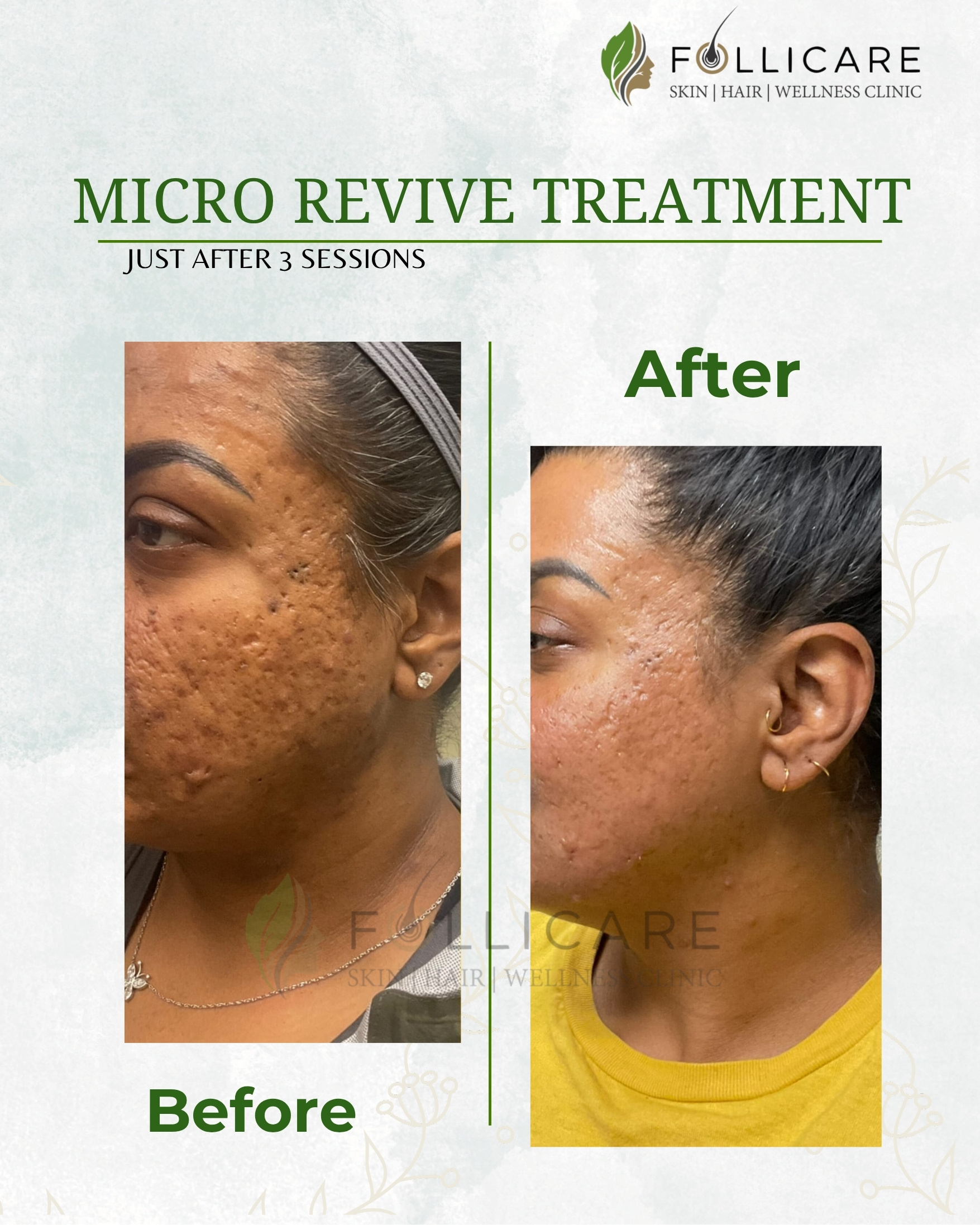 Face PRP treatment before and after result in Nellore
