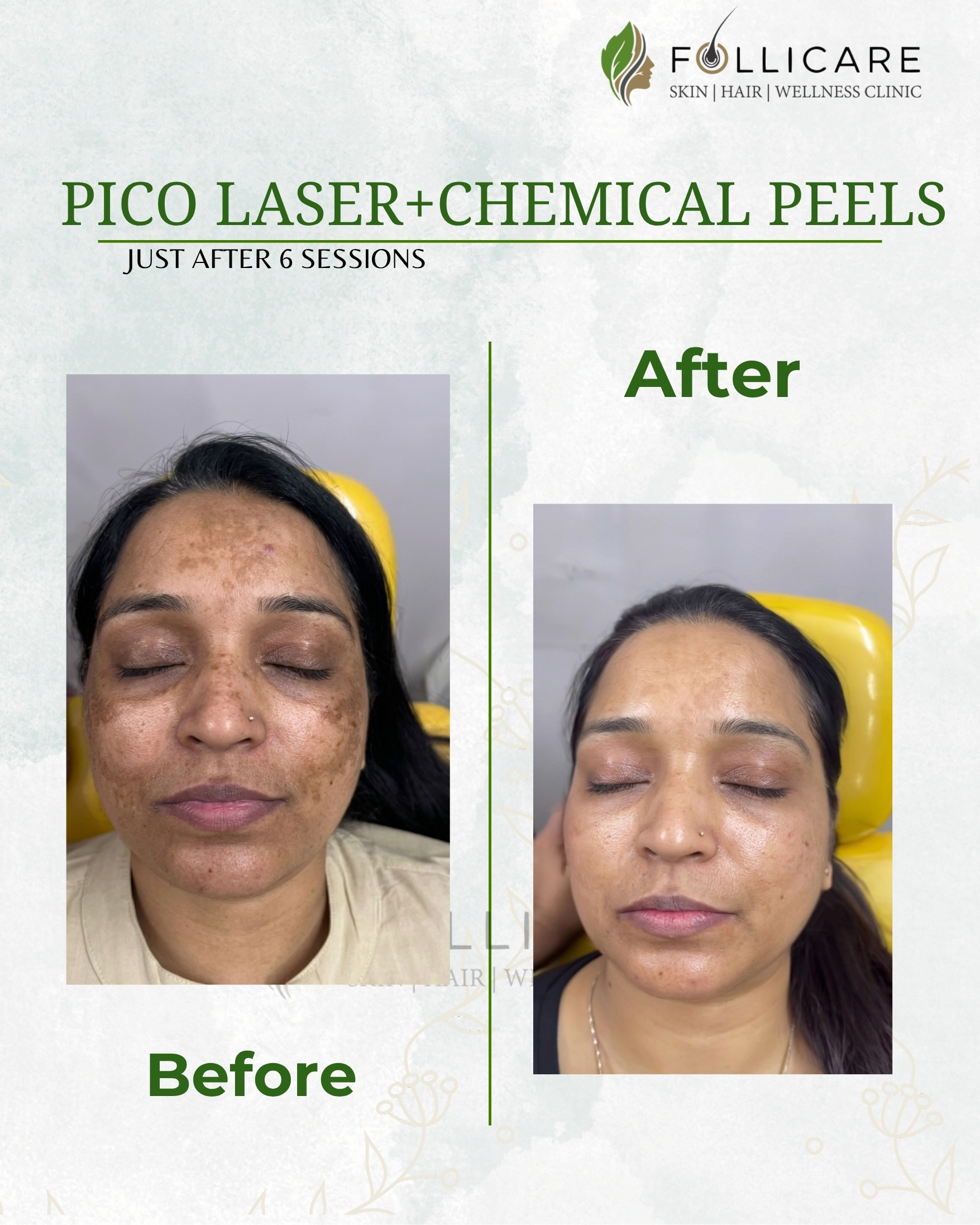 Face PRP treatment result Nellore