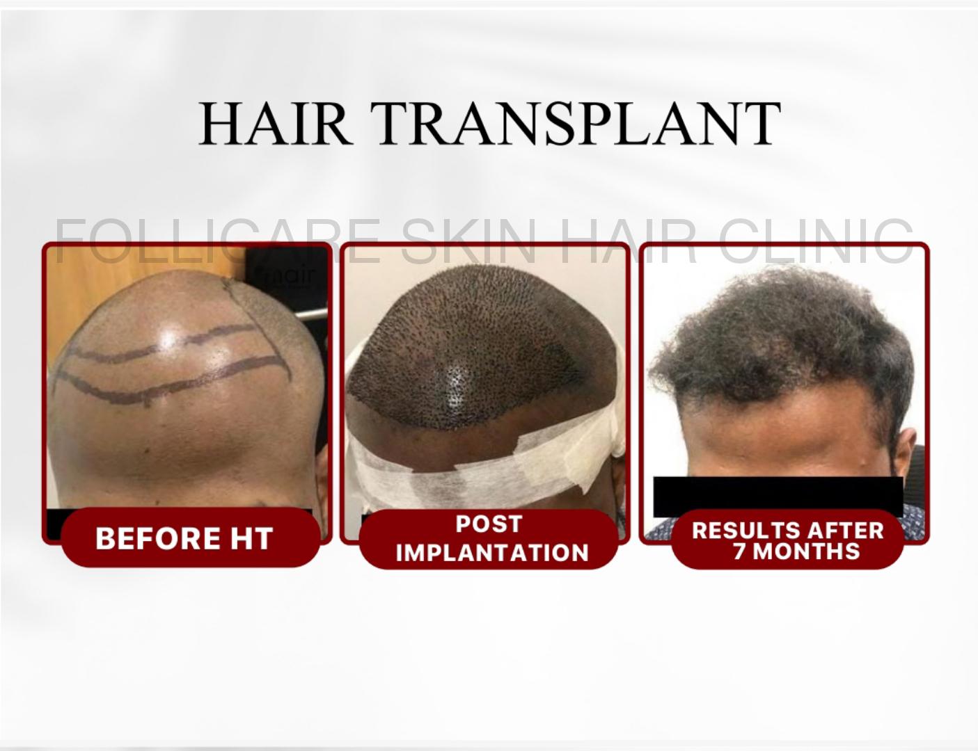 Acne Treatment Result Nellore