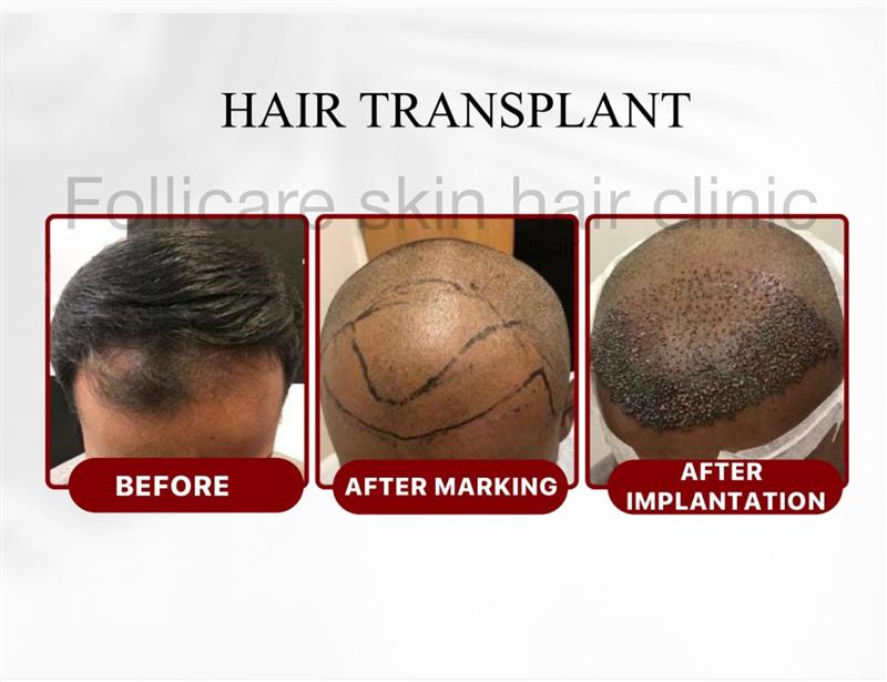 Hair Transplant Result