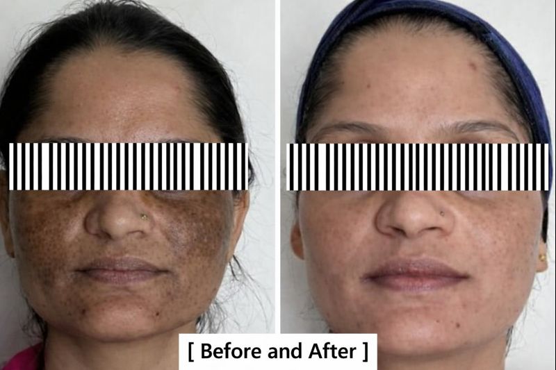 Skin Whitening Result Nellore