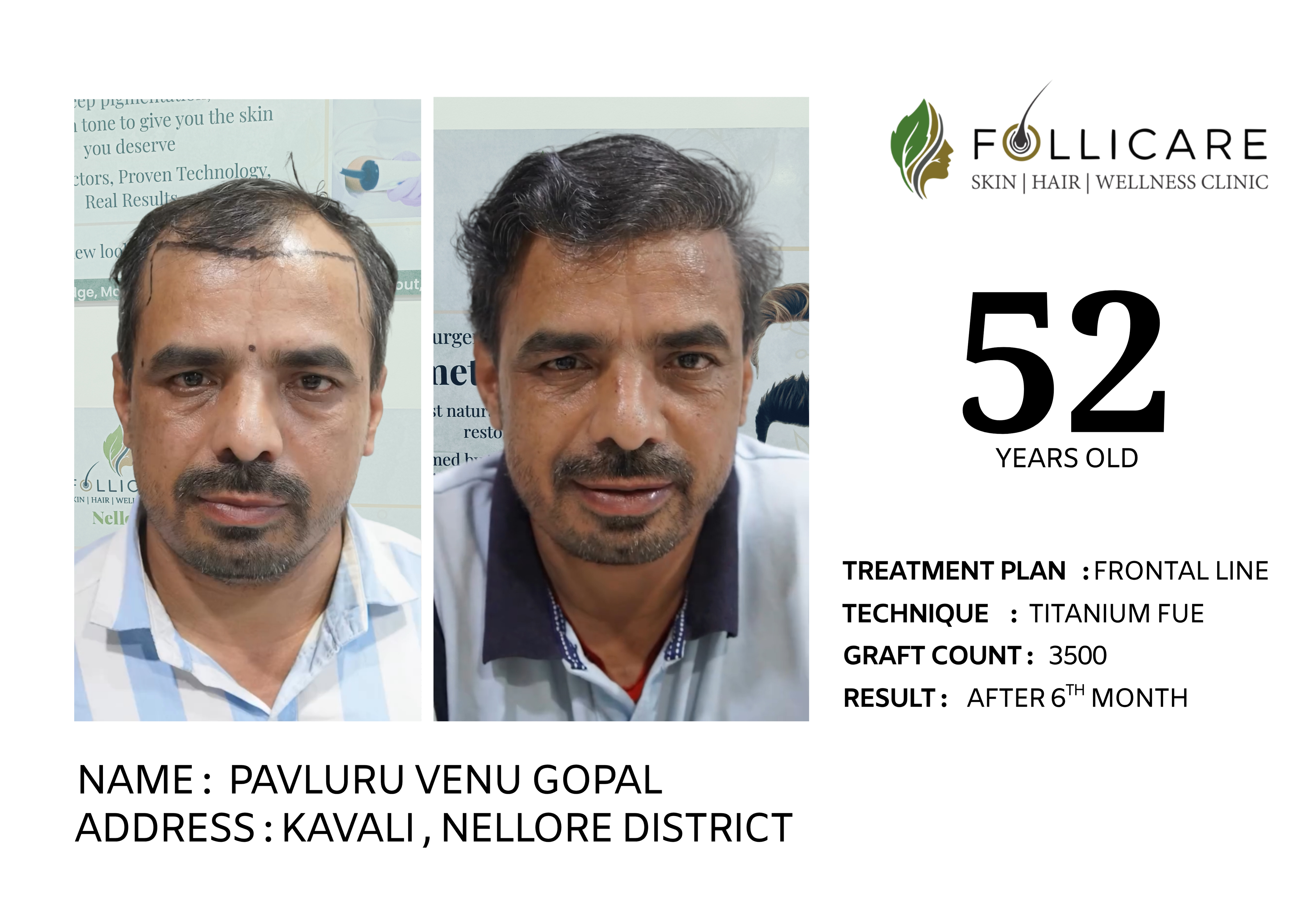 Hair transplant result Nellore