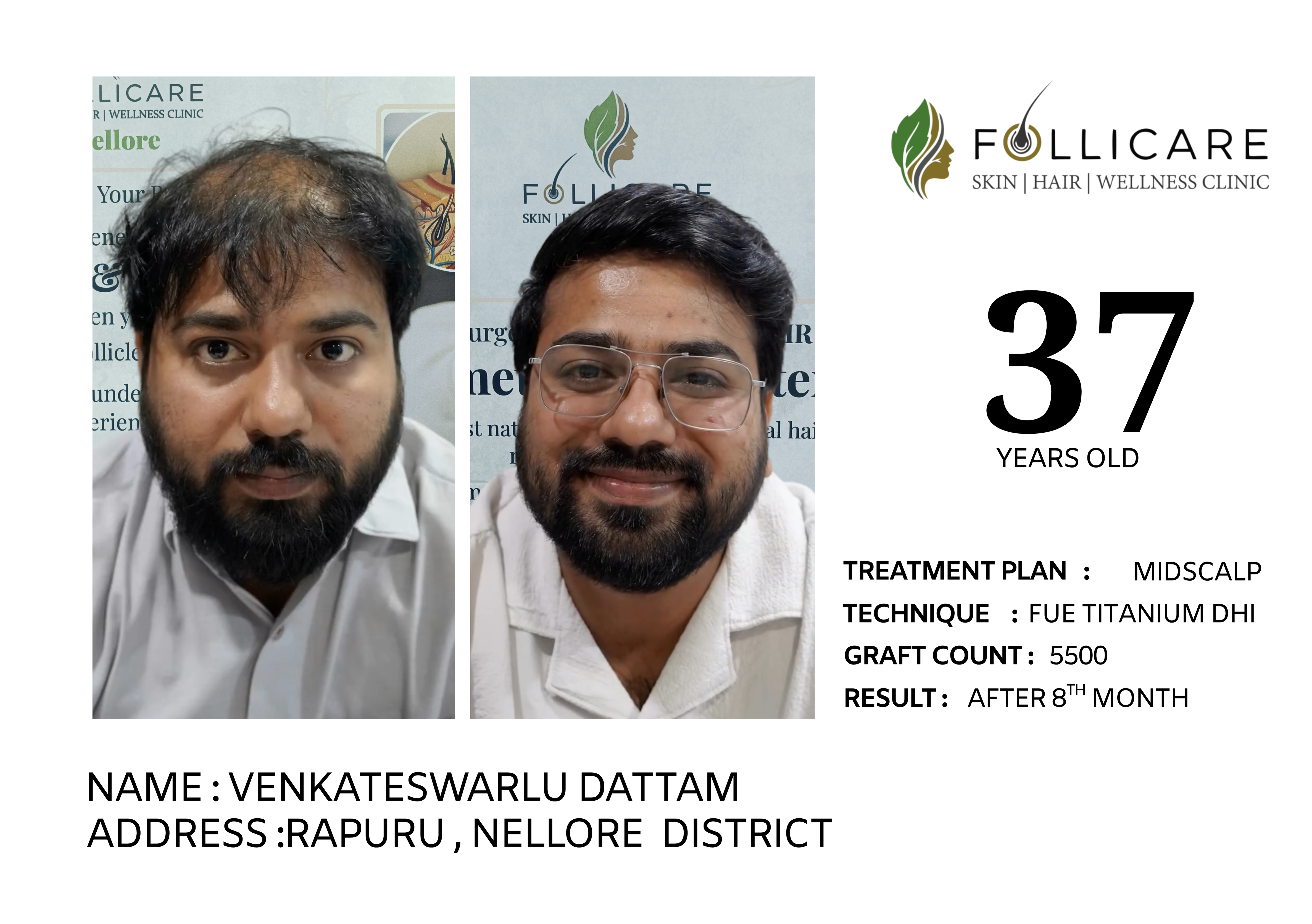 Hair transplant result Nellore