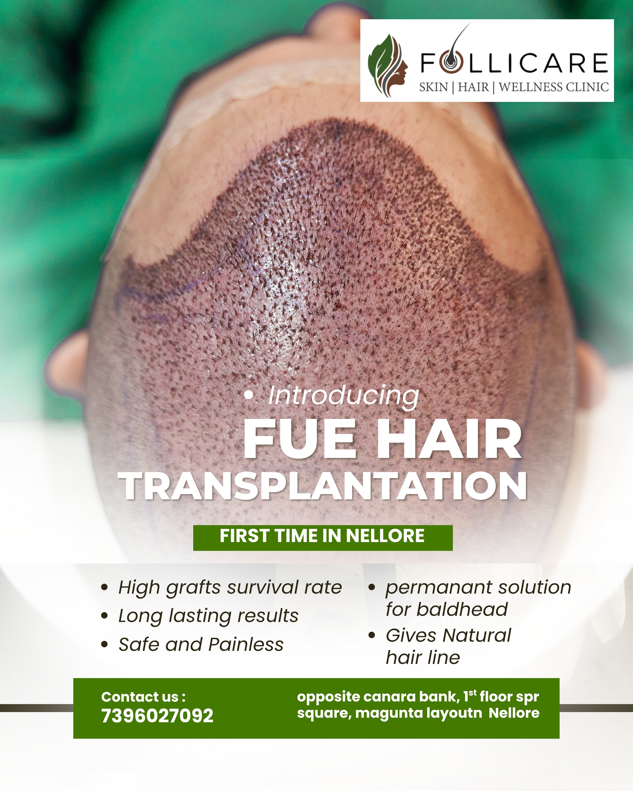 Hair transplantation procedure at Follicare, Nellore