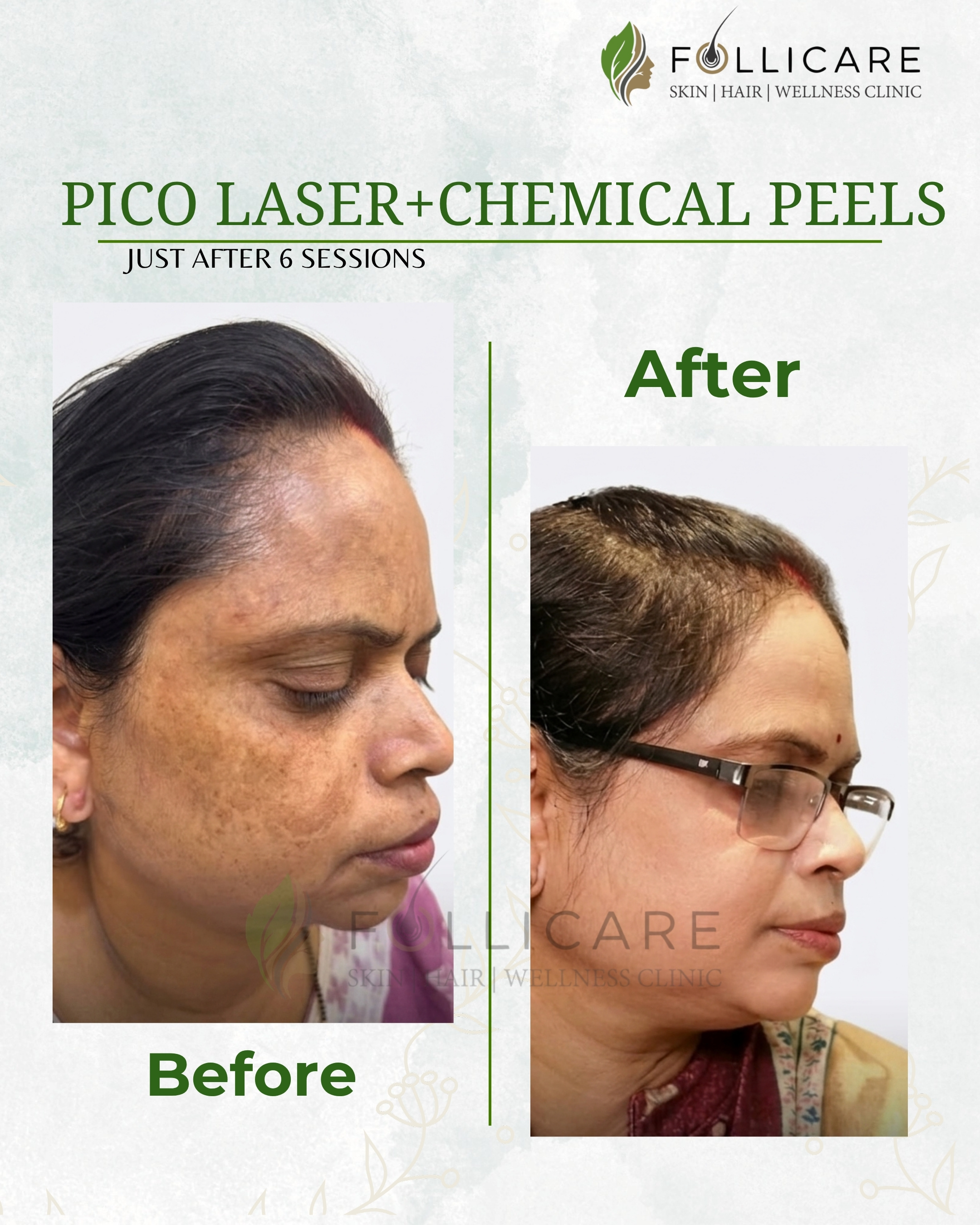 Yellow complex peel before and after result in Nellore