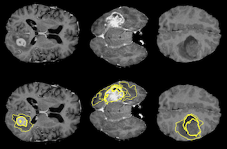 Diversity of tumor size, shape and location