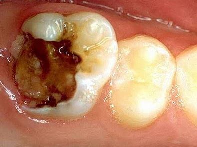 Gigi berlubang penyebab rasa sakit di gigi