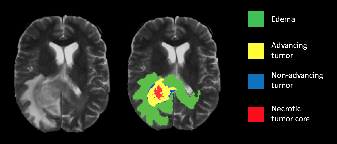 brain tumor segmentation research paper