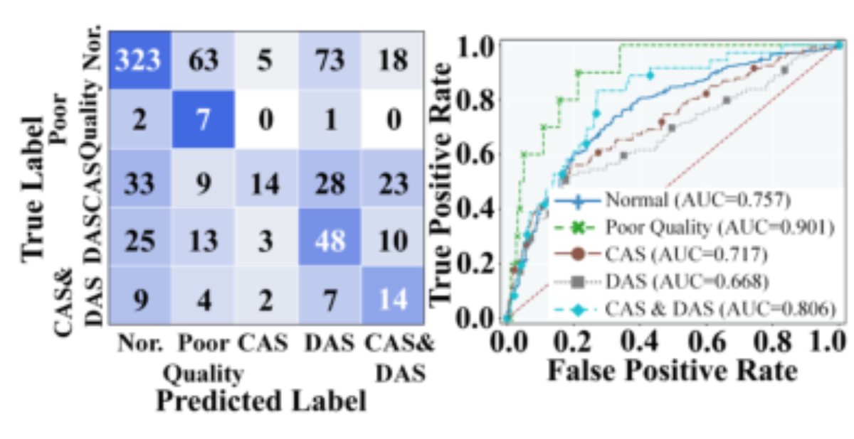原论文 Figure 4:Confusion matrices and ROC curves on the SPRSound 2022 dataset for Task 2-2.
