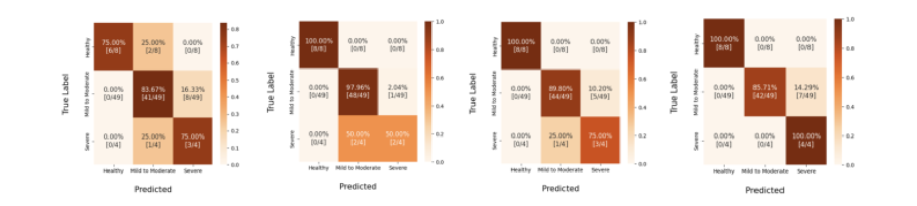 原论文 Figure 7：Confusion matrices of severity classification results for four different feature combinations:…
