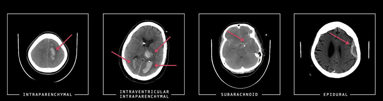 Examples of ICH